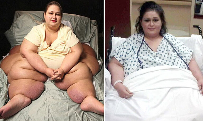 The World’s Most Obese Woman Goes Through An Amazing Transformation